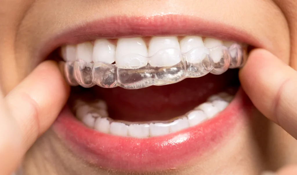 entretien gouttieres invisibles conseils docteur baurBien entretenir ses gouttièresCabinet d’Orthodontie du Dr Bernard Baur