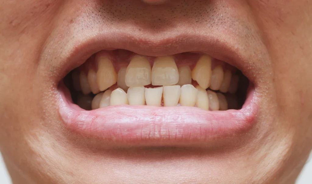 malocclusion chevauchement dentaireMalocclusion dentaireCabinet d’Orthodontie du Dr Bernard Baur