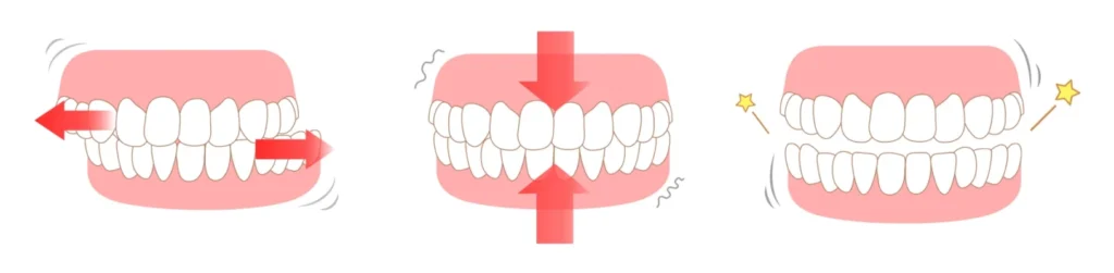 traitement bruxisme docteur baur truchtersheimBruxismeCabinet d’Orthodontie du Dr Bernard Baur