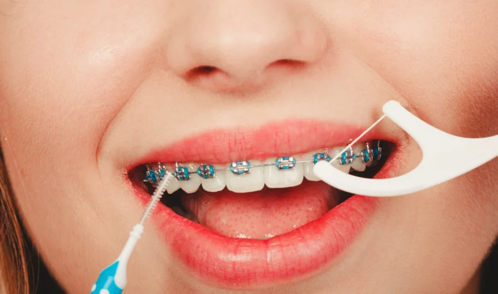 hygiene bucco dentaire multi attaches dr baurAppareils dentairesCabinet d’Orthodontie du Dr Bernard Baur