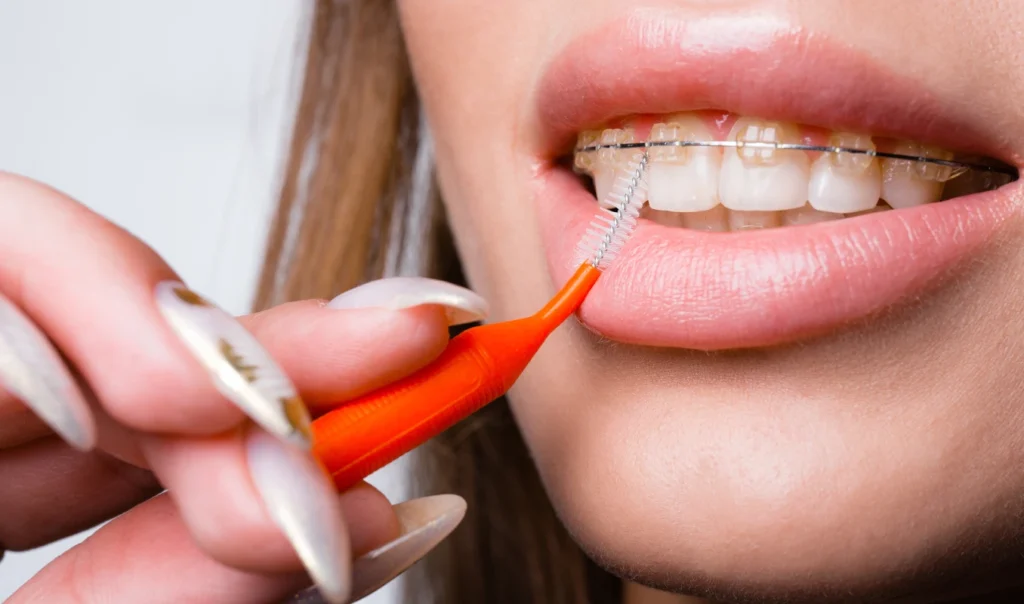 hygiene bucco dentaire multi bagues dr baurAppareils dentairesCabinet d’Orthodontie du Dr Bernard Baur