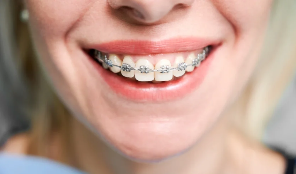 multi attaches adultes orthodontiste docteur baurAppareils dentairesCabinet d’Orthodontie du Dr Bernard Baur