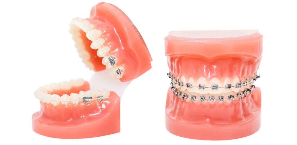 multi attaches metalliques ceramiques orthodontiste truchtersheimAppareils dentairesCabinet d’Orthodontie du Dr Bernard Baur